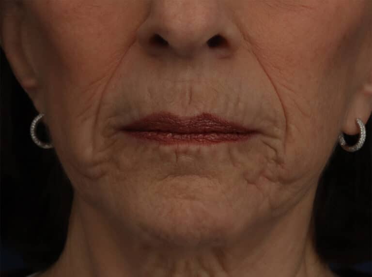 Before Image: Laser Resurfacing - front