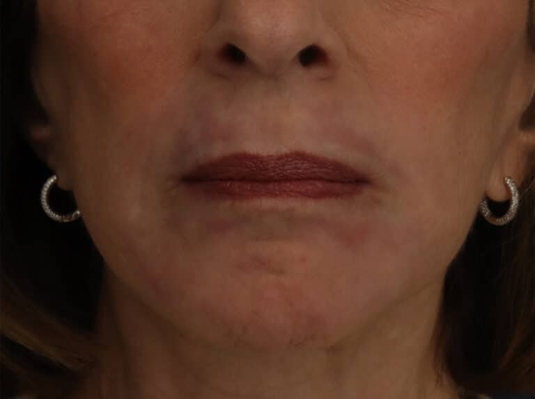 After Image: Laser Resurfacing - front