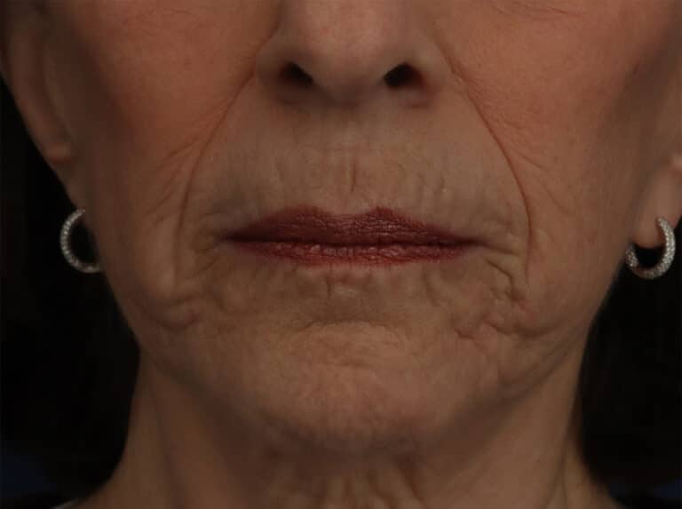 Before Image: Laser Resurfacing - front