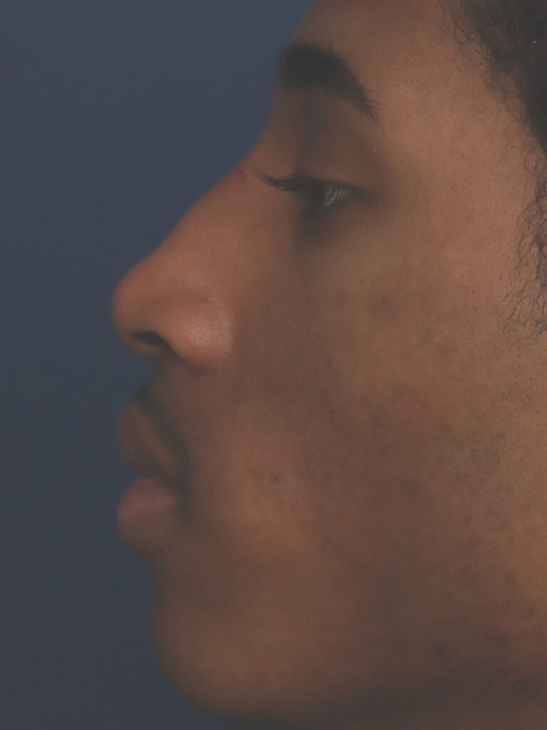 After Image: Non-Surgical Nose job with Injectable Fillers - left-side
