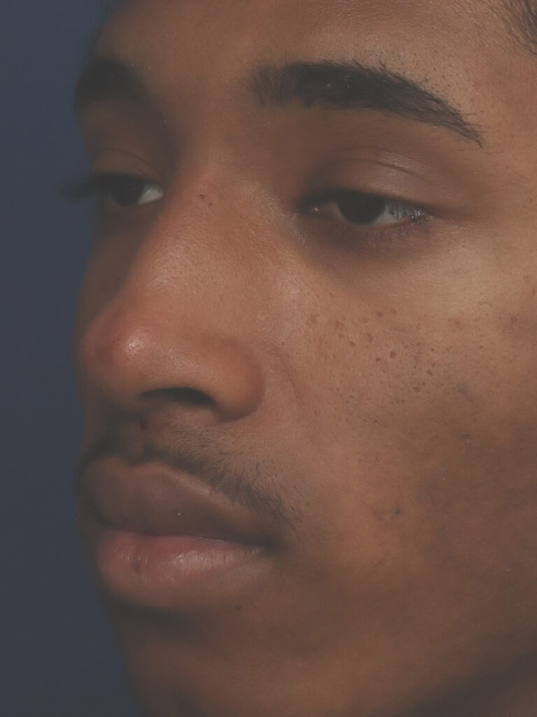 After Image: Non-Surgical Nose job with Injectable Fillers - left-front-oblique