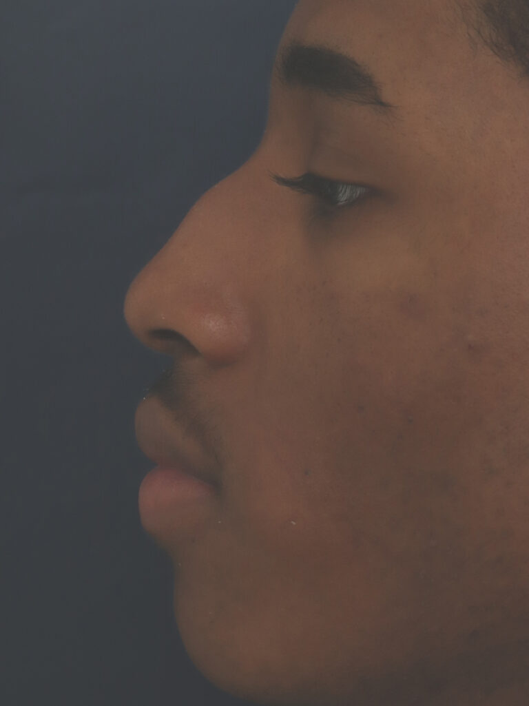 Before Image: Non-Surgical Nose job with Injectable Fillers - left-side