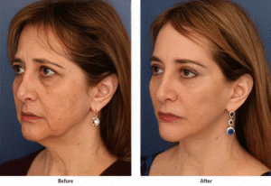 Before and after images of woman who had a deep plane facelift
