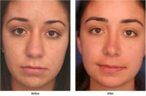 Before-and-after image showing results of 18 year old woman after having rhinoplasty surgery.