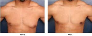 Before and after image of man who had breast reduction surgery to correct one side of his chest that had glandular gynecomastia