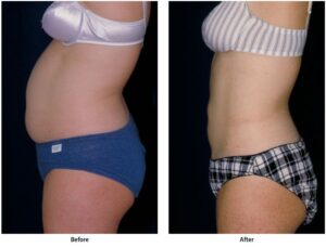 Before and after images of woman who had successful liposuction surgery to flatten her abdomen area.