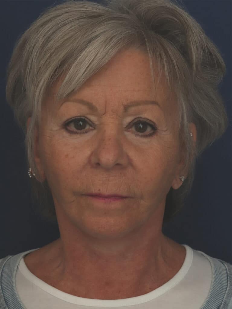 After Image: Facelift, Mini Temporal Lift and Chin Implant - front