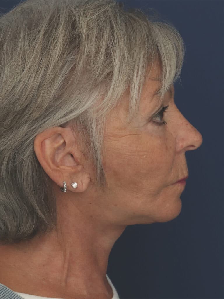 After Image: Facelift, Mini Temporal Lift and Chin Implant - right-side