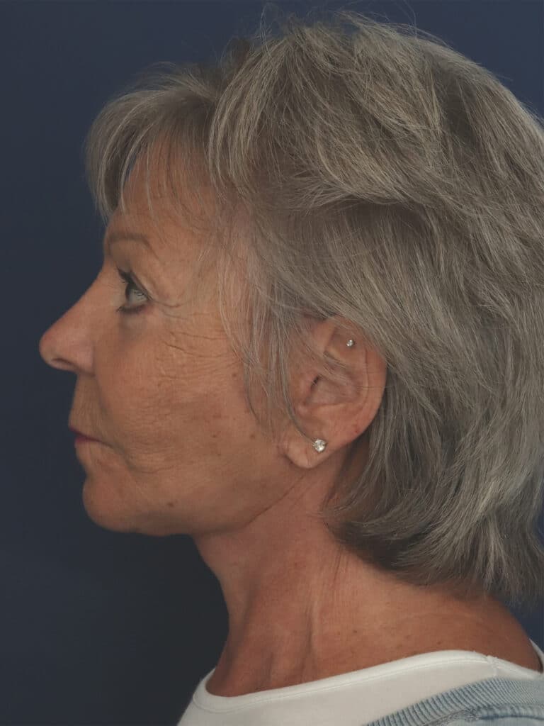 After Image: Facelift, Mini Temporal Lift and Chin Implant - left-side