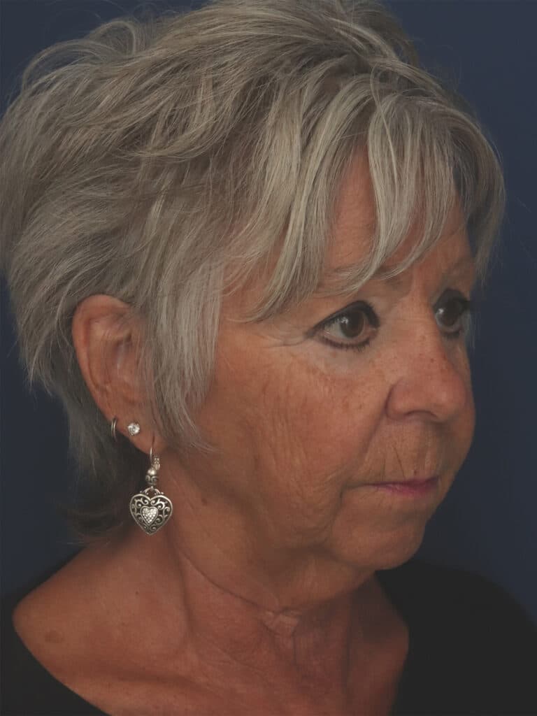 Before Image: Facelift, Mini Temporal Lift and Chin Implant - right-front-oblique