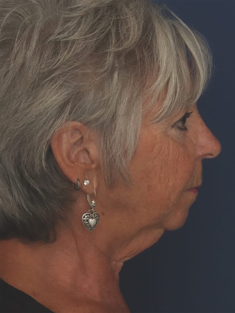 Before Image: Facelift, Mini Temporal Lift and Chin Implant - right-side