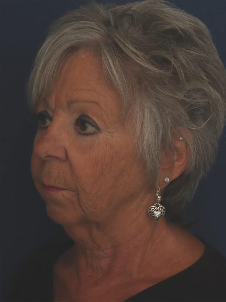 Before Image: Facelift, Mini Temporal Lift and Chin Implant - left-front-oblique