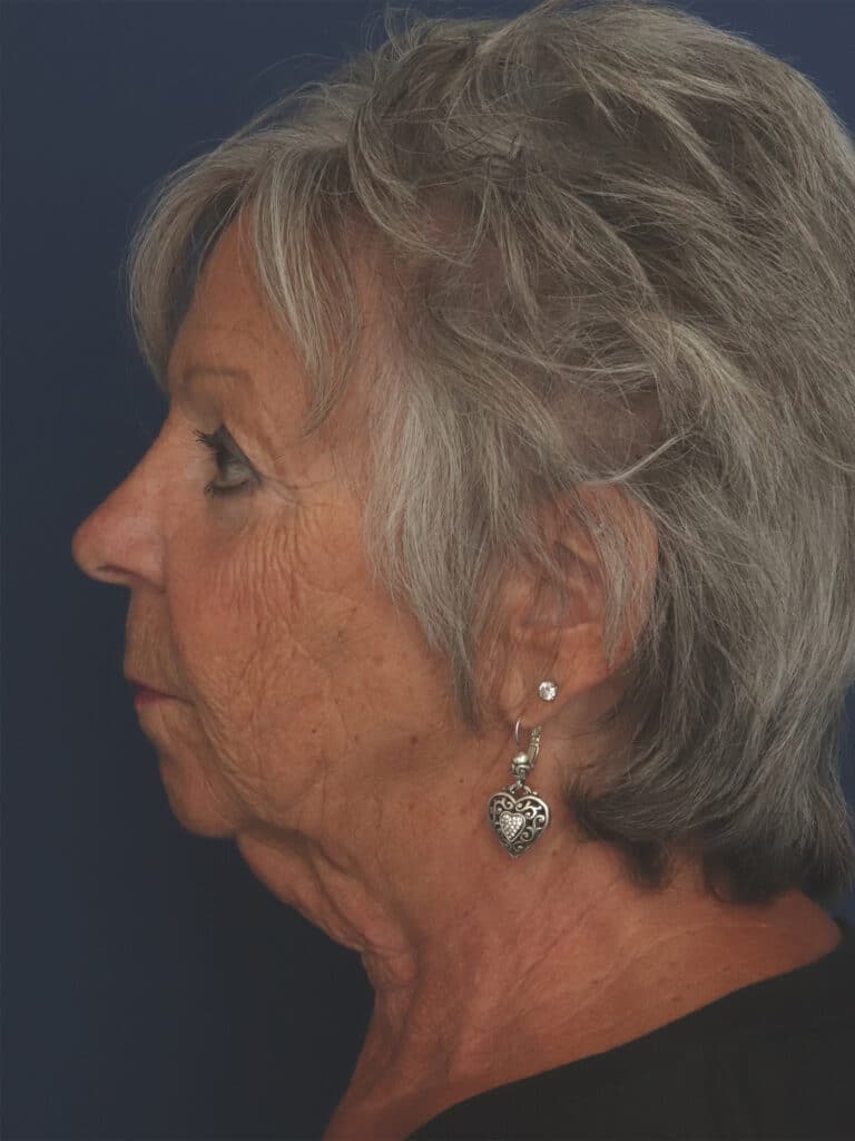Before Image: Facelift, Mini Temporal Lift and Chin Implant - left-side