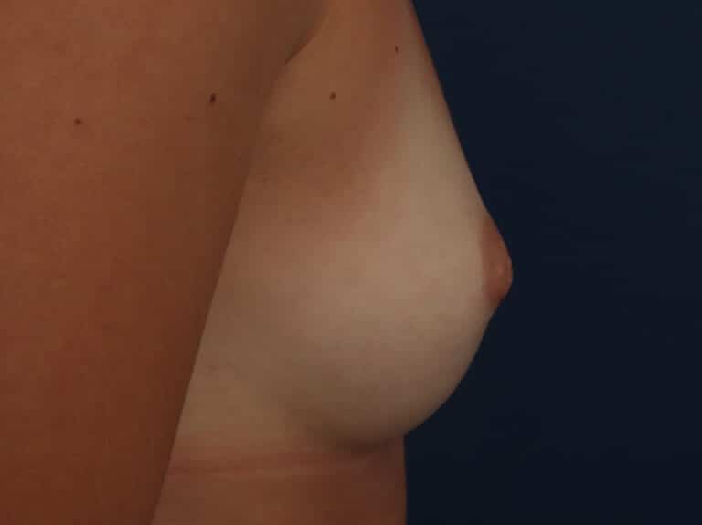 Before Image: Inverted Nipple - right-side