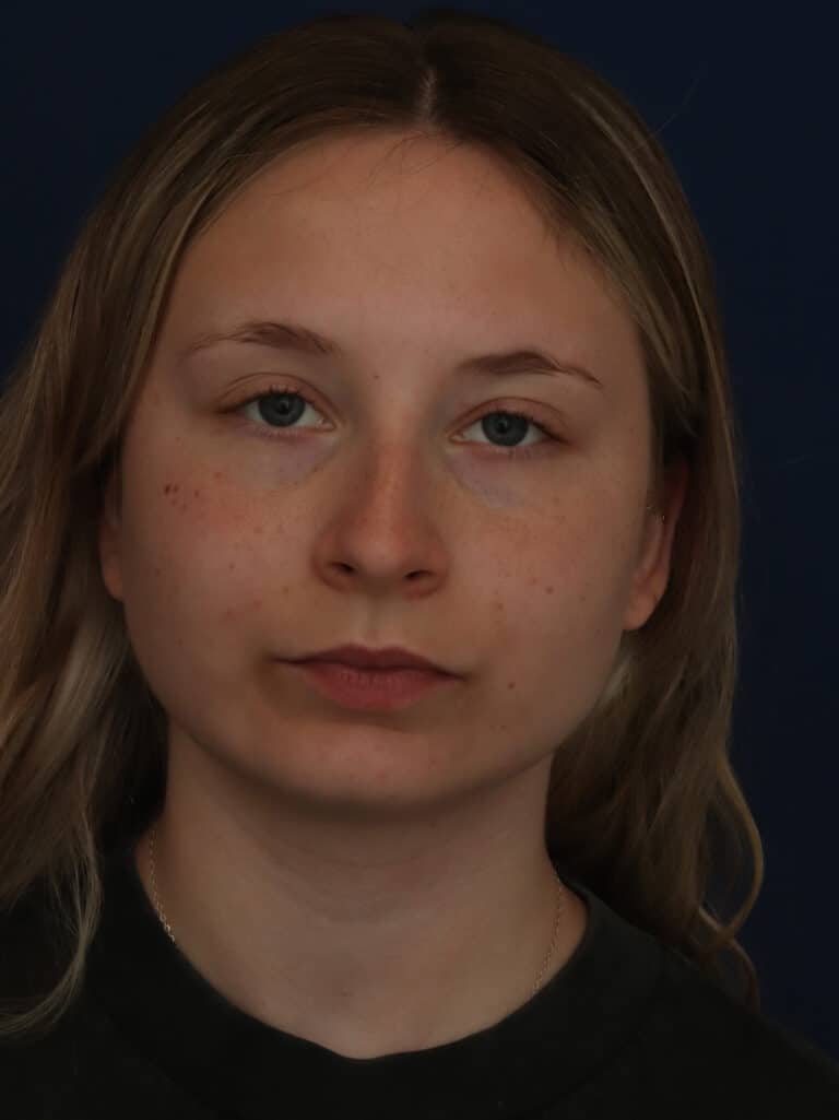 After Image: Neck/Submental Liposuction - front