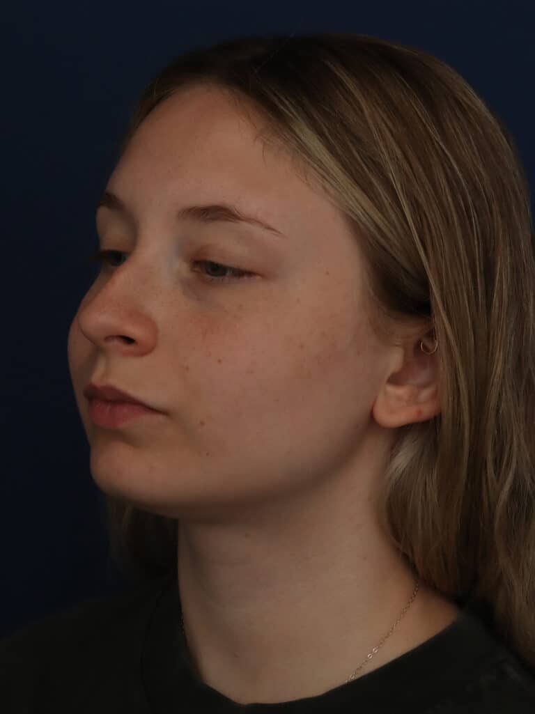 After Image: Neck/Submental Liposuction - left-front-oblique