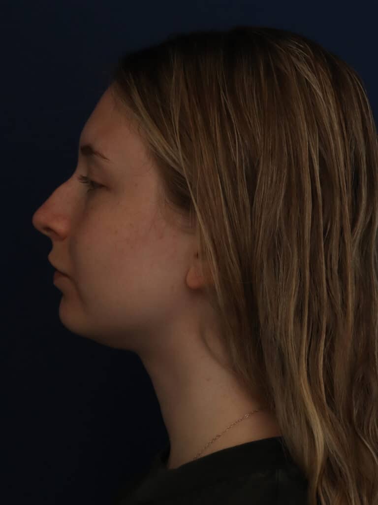 After Image: Neck/Submental Liposuction - left-side