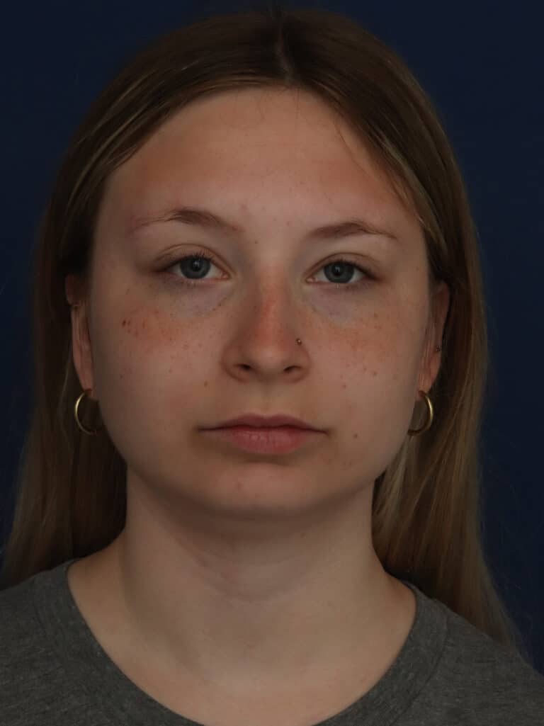 Before Image: Neck/Submental Liposuction - front