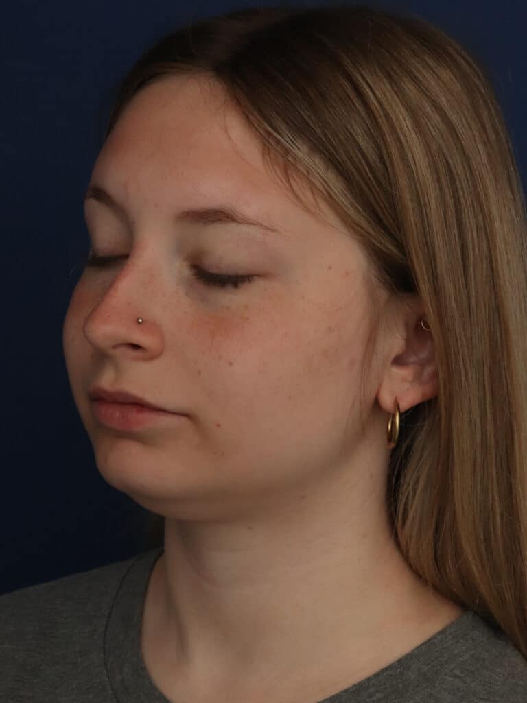 Before Image: Neck/Submental Liposuction - left-front-oblique