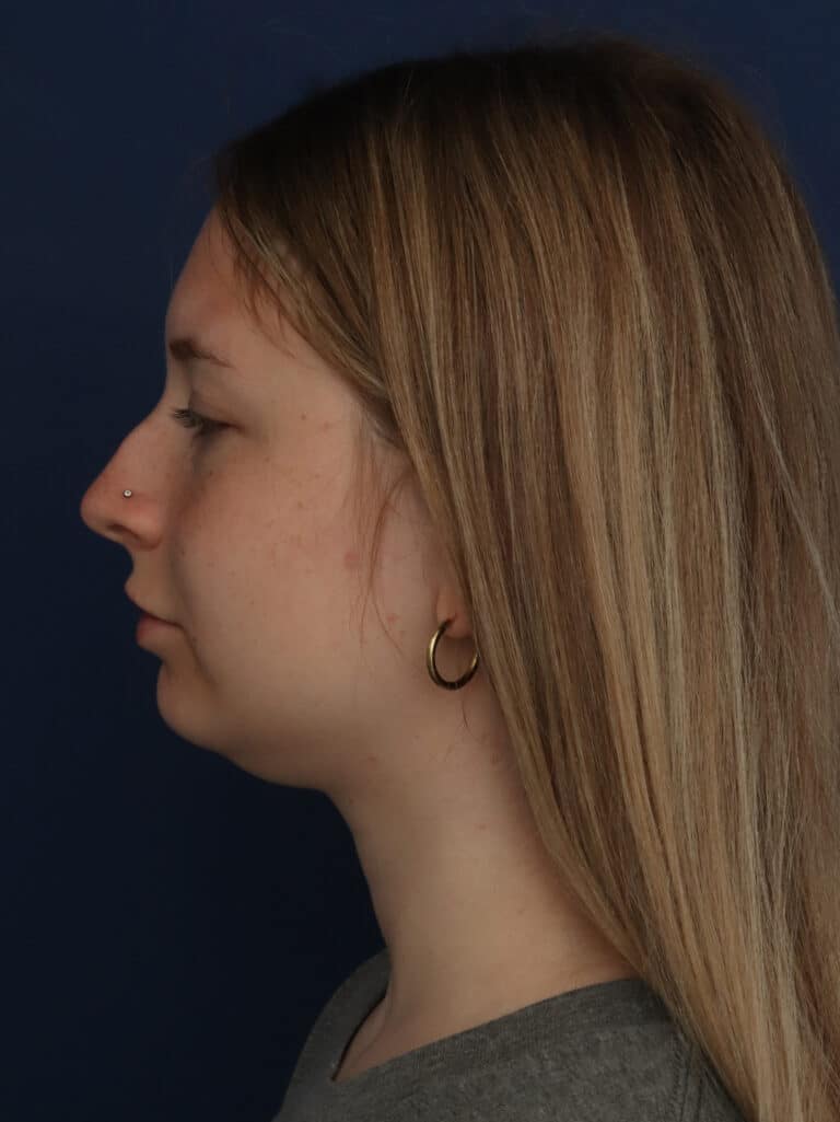 Before Image: Neck/Submental Liposuction - left-side