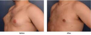 Before and after images of man who had successful male breast reduction to address gynecomastia