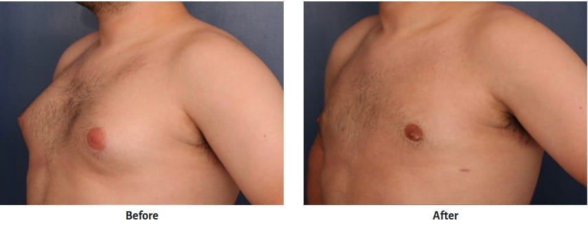 semaglutide gynecomastia Spironolactone-Induced Do GLP-1 Weight Loss Drugs