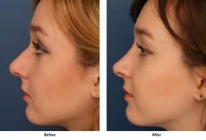 Before and after images showing young adult woman's results after rhinoplasty from side profile.