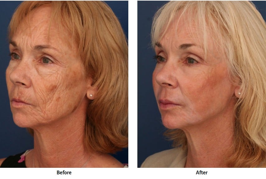 Before & after image of woman who had fat grafting done to help with wrinkles