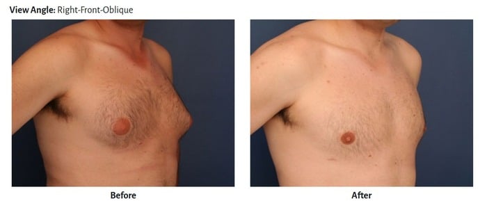 Before and after images showing results of male breast reduction surgery