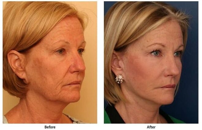 Before and after images showing woman improving under-eye bags with lower eyelid surgery, showing no visible scars. Before and after images showing results of woman who had a facelift