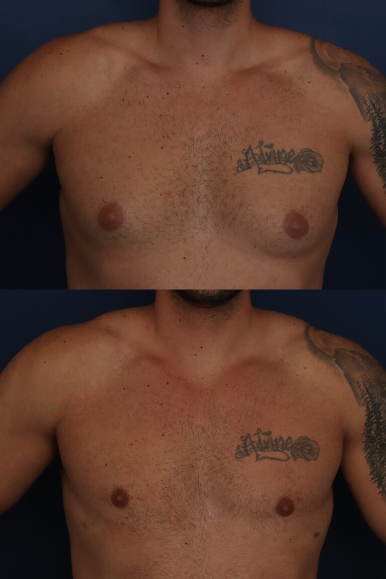 Before Image: 37 year old young man with correction of gynecomastia using Lateral Pull Through technique - front