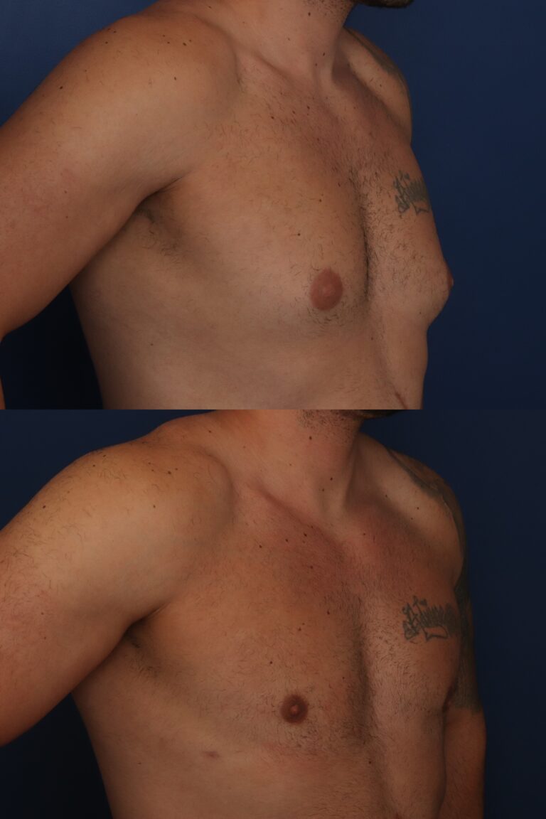After Image: 37 year old young man with correction of gynecomastia using Lateral Pull Through technique - front