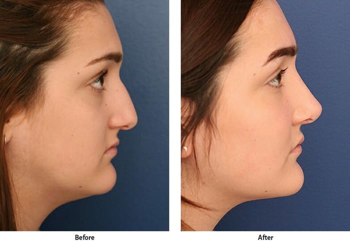 Before and after images of young woman who had rhinoplasty surgery