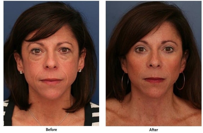 Before and after images showing woman's rejuvenated facial contours after having a facelift.