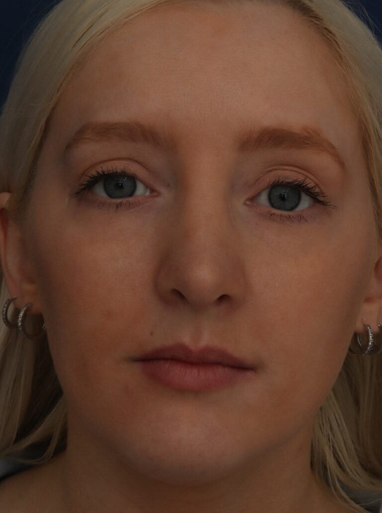 After Image: Septorhinoplasty - front