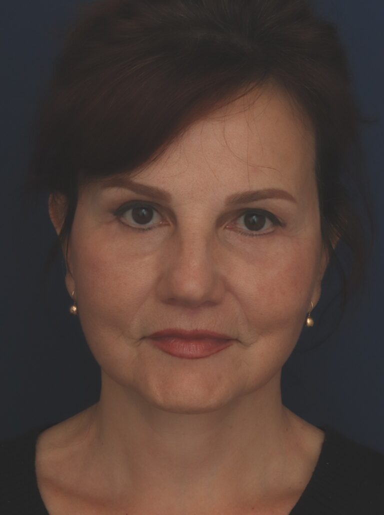 After Image: Deep Plane Facelift - front