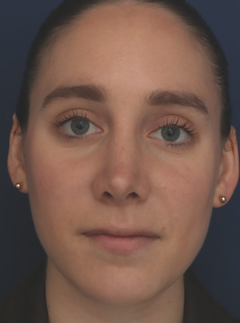After Image: Rhinoplasty - front