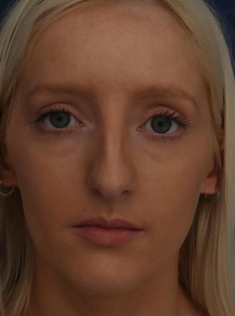 Before Image: Septorhinoplasty - front