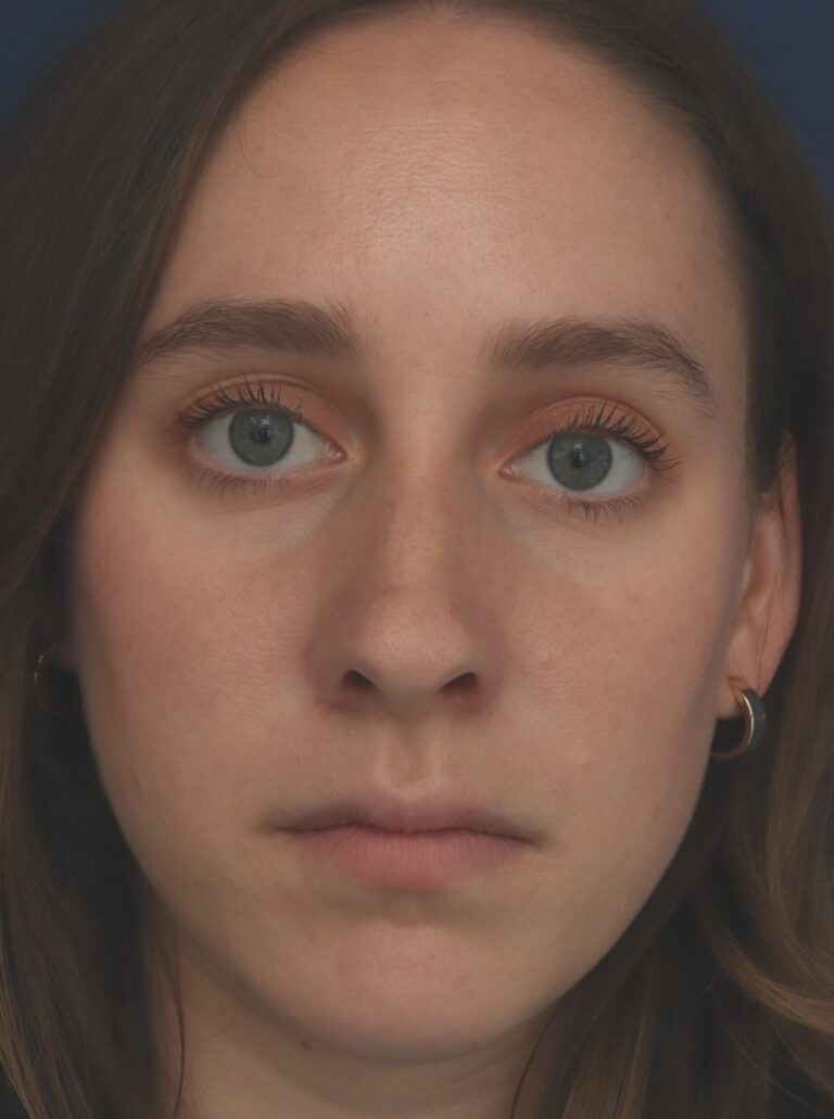 Before Image: Rhinoplasty - front