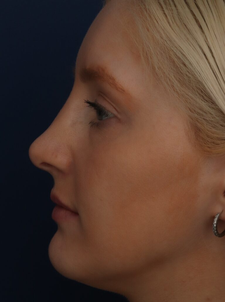After Image: Septorhinoplasty - left-side