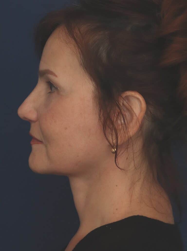 After Image: Deep Plane Facelift - left-side