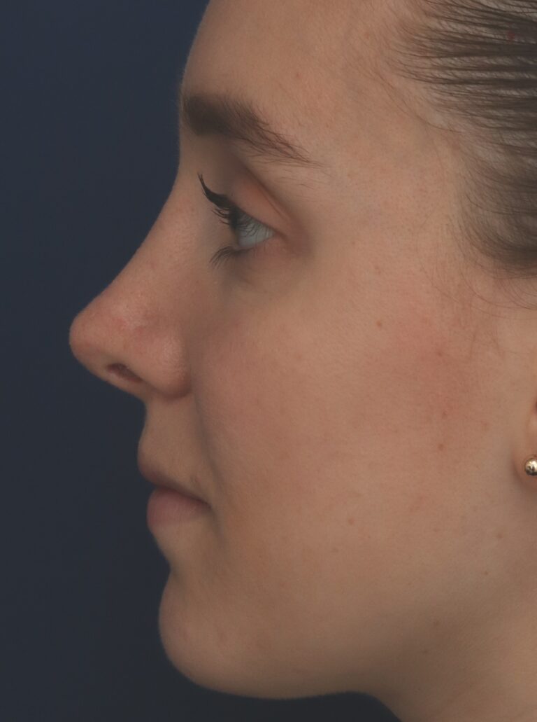 After Image: Rhinoplasty - left-side