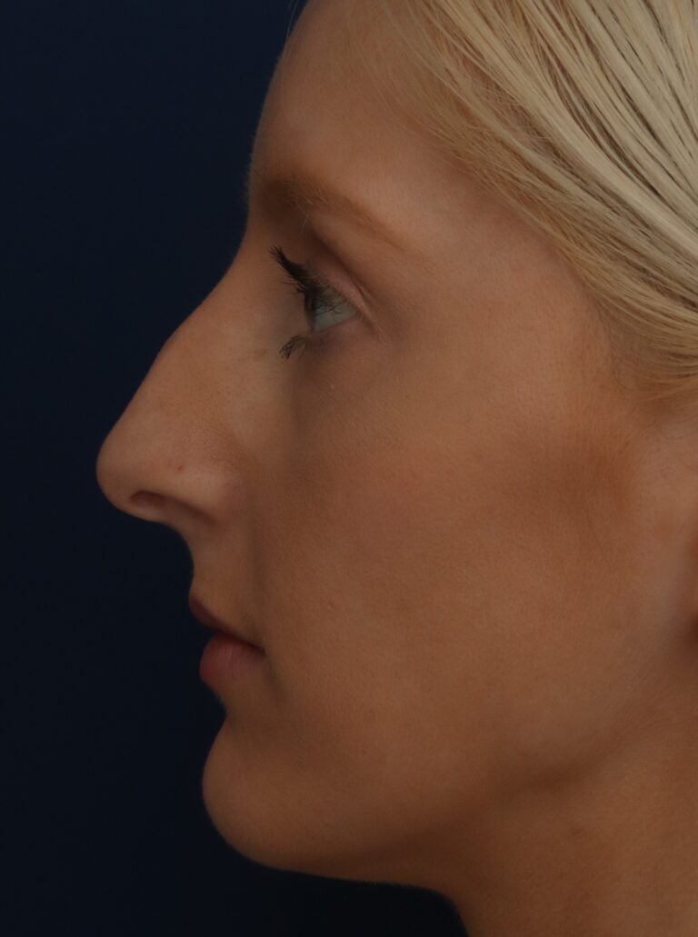 Before Image: Septorhinoplasty - left-side
