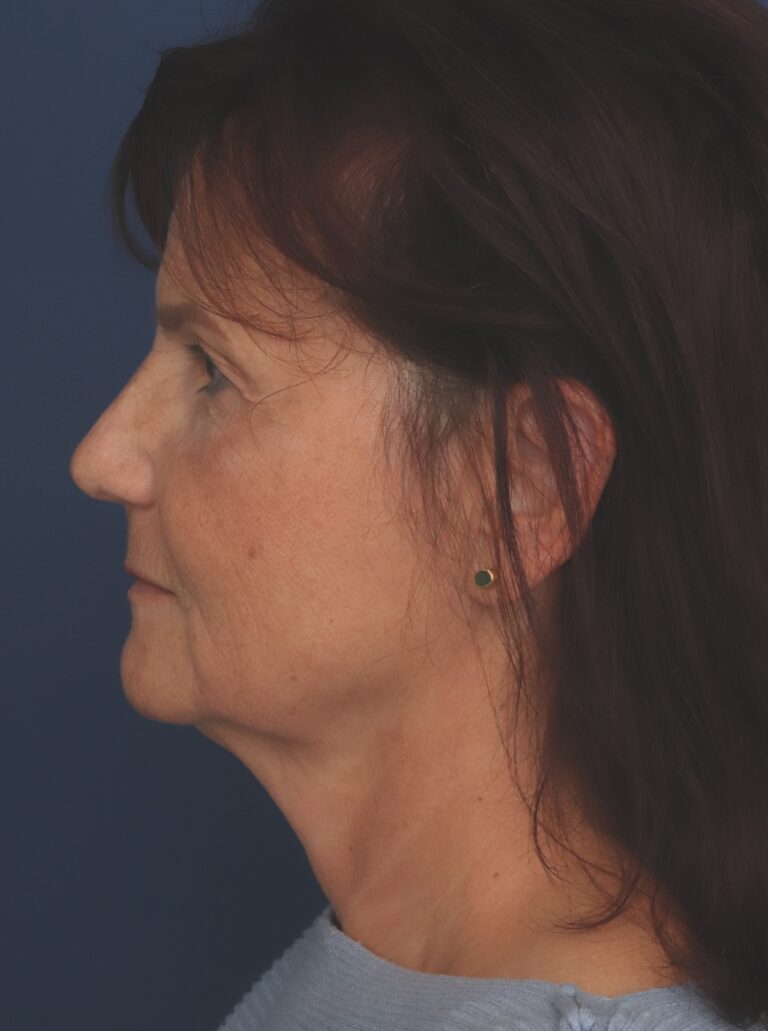 Before Image: Deep Plane Facelift - left-side