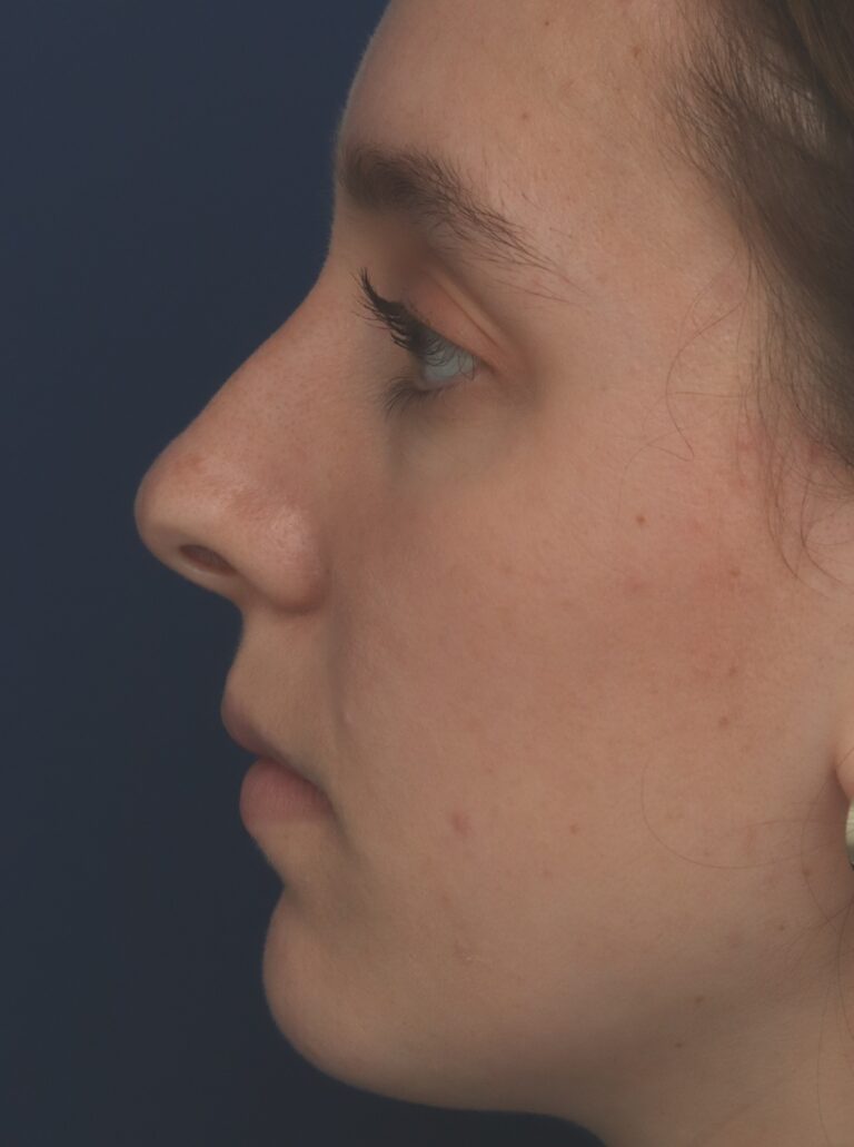 Before Image: Rhinoplasty - left-side