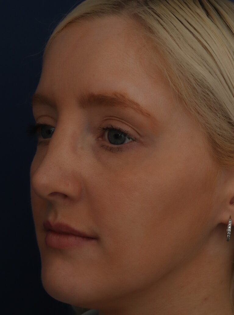After Image: Septorhinoplasty - left-front-oblique