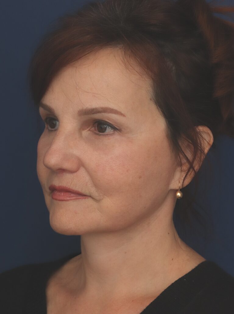 After Image: Deep Plane Facelift - left-front-oblique