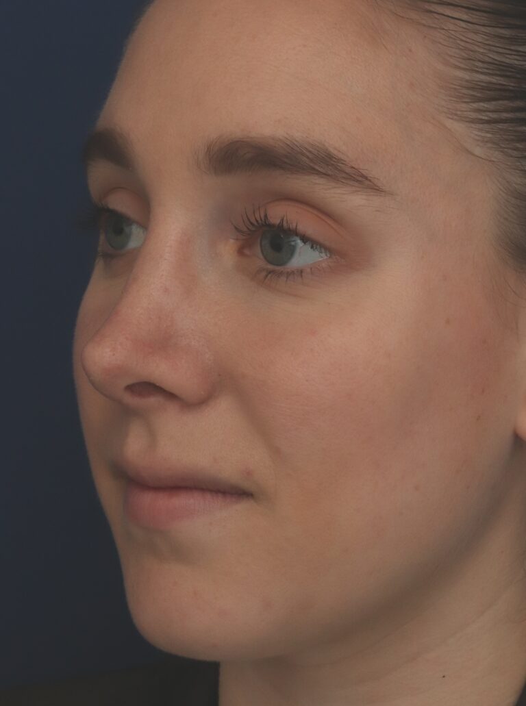 After Image: Rhinoplasty - left-front-oblique
