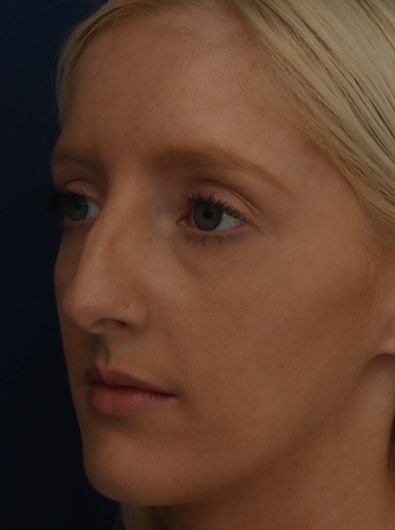 Before Image: Septorhinoplasty - left-front-oblique