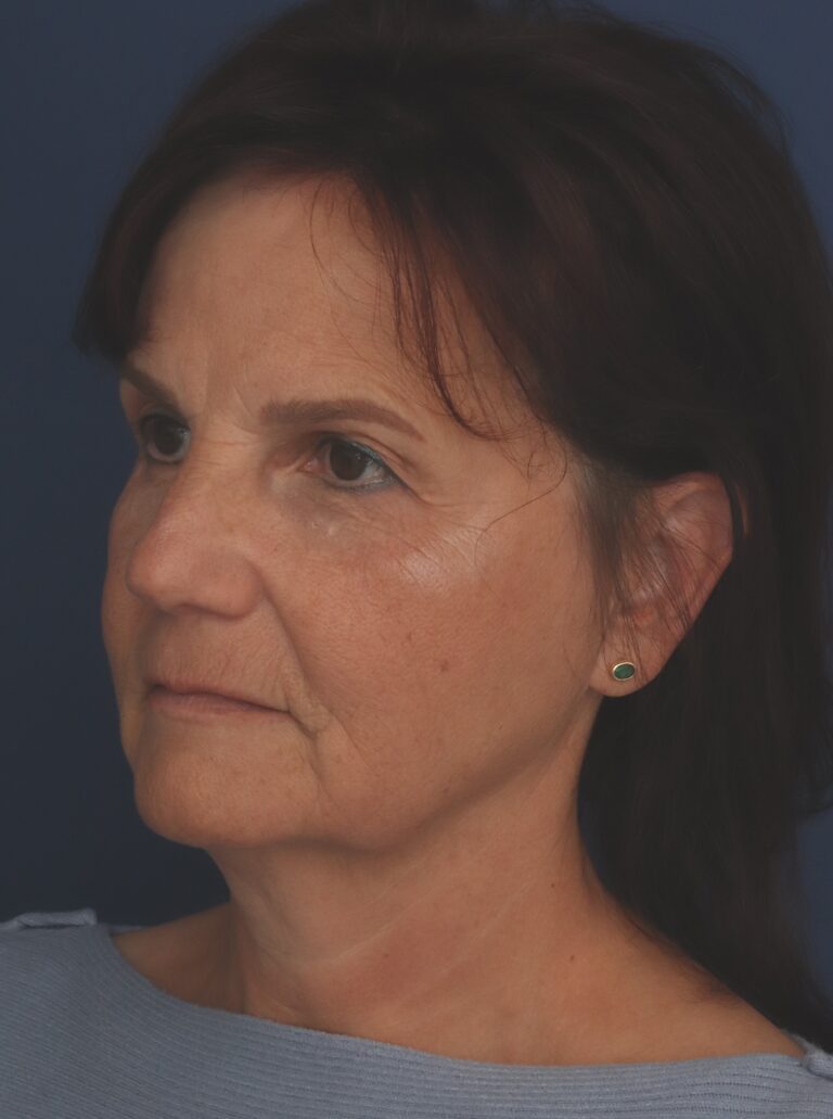 Before Image: Deep Plane Facelift - left-front-oblique